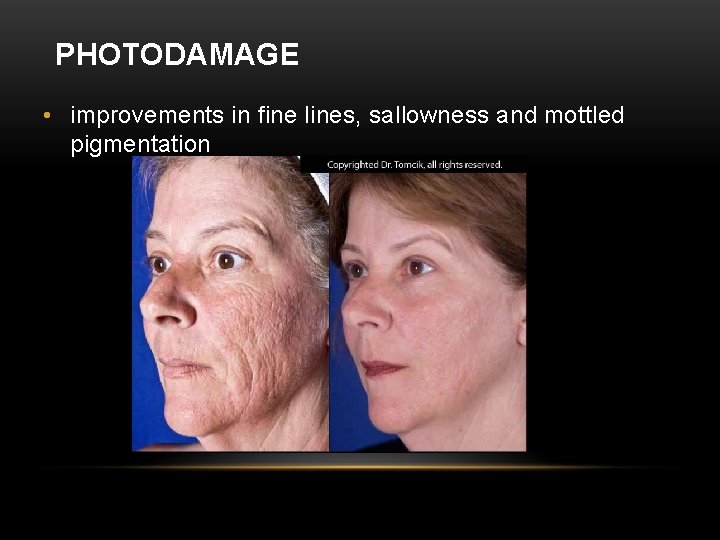 PHOTODAMAGE • improvements in fine lines, sallowness and mottled pigmentation 