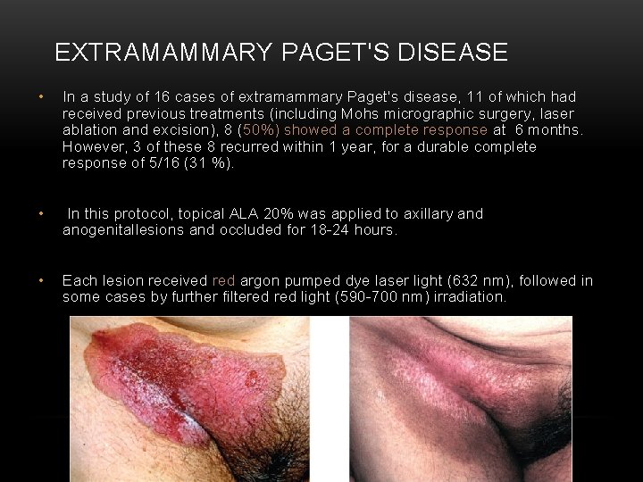 EXTRAMAMMARY PAGET'S DISEASE • In a study of 16 cases of extramammary Paget's disease,