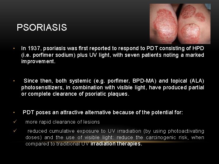 PSORIASIS • In 1937, psoriasis was first reported to respond to PDT consisting of