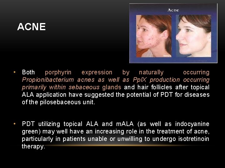 ACNE • Both porphyrin expression by naturally occurring Propionibacterium acnes as well as Ppl.