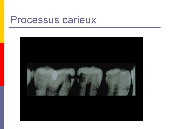 Processus carieux Processus carieux