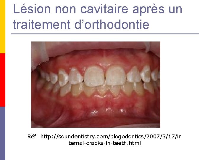 Lésion non cavitaire après un traitement d’orthodontie Réf. : http: //soundentistry. com/blogodontics/2007/3/17/in ternal-cracks-in-teeth. html Lésion non cavitaire après un traitement d’orthodontie Réf. : http: //soundentistry. com/blogodontics/2007/3/17/in ternal-cracks-in-teeth. html
