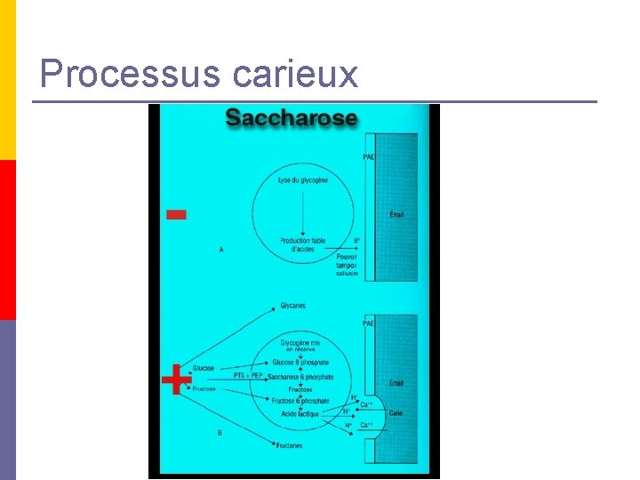 Processus carieux Processus carieux