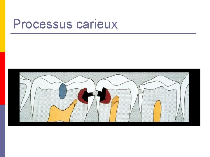 Processus carieux Processus carieux