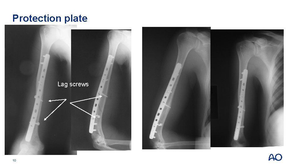Protection plate Lag screws 10 Protection plate Lag screws 10