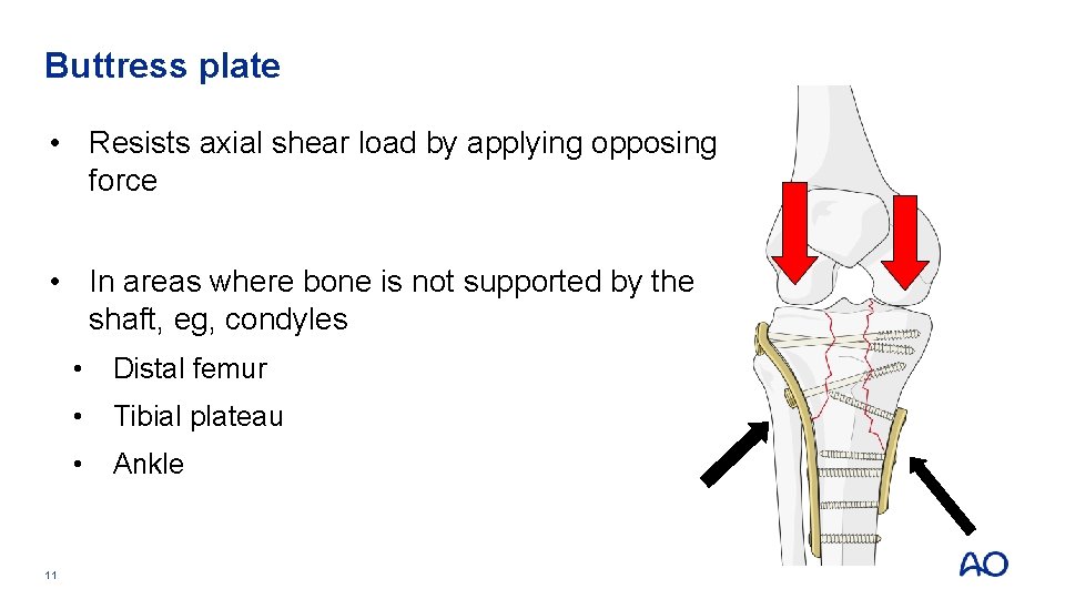 Buttress plate • Resists axial shear load by applying opposing force • In areas Buttress plate • Resists axial shear load by applying opposing force • In areas
