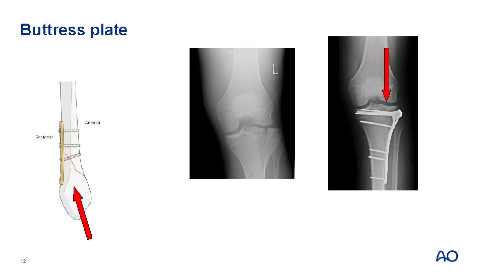 Buttress plate 12 Buttress plate 12