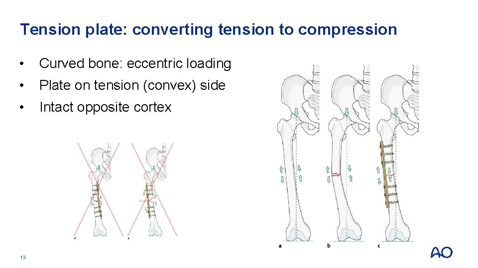 Tension plate: converting tension to compression • Curved bone: eccentric loading • Plate on Tension plate: converting tension to compression • Curved bone: eccentric loading • Plate on