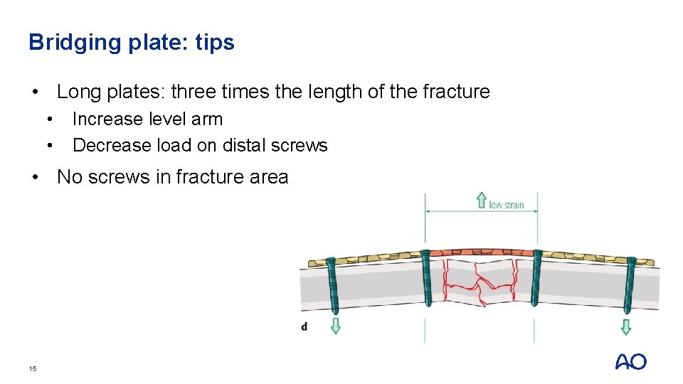 Bridging plate: tips • Long plates: three times the length of the fracture • Bridging plate: tips • Long plates: three times the length of the fracture •