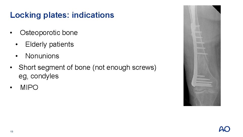 Locking plates: indications • Osteoporotic bone • Elderly patients • Nonunions • Short segment Locking plates: indications • Osteoporotic bone • Elderly patients • Nonunions • Short segment