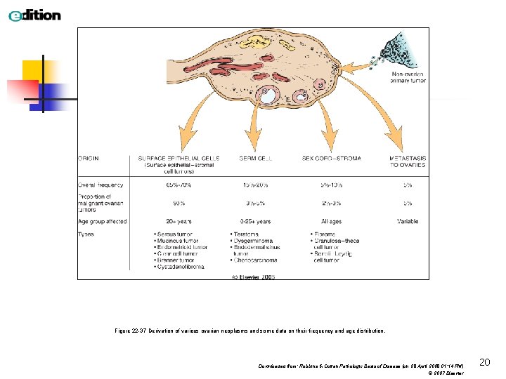 Figure 22 -37 Derivation of various ovarian neoplasms and some data on their frequency