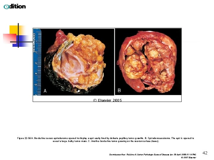 Figure 22 -39 A, Borderline serous cystadenoma opened to display a cyst cavity lined