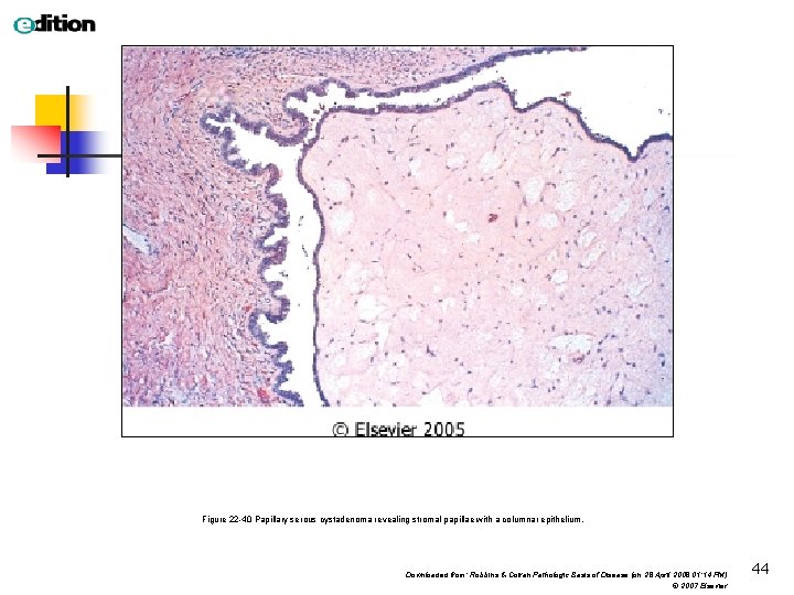 Figure 22 -40 Papillary serous cystadenoma revealing stromal papillae with a columnar epithelium. Downloaded