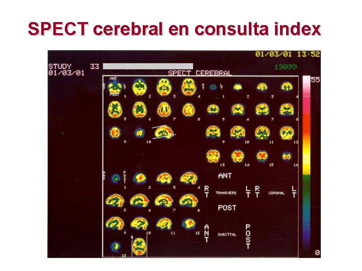 SPECT cerebral en consulta index 