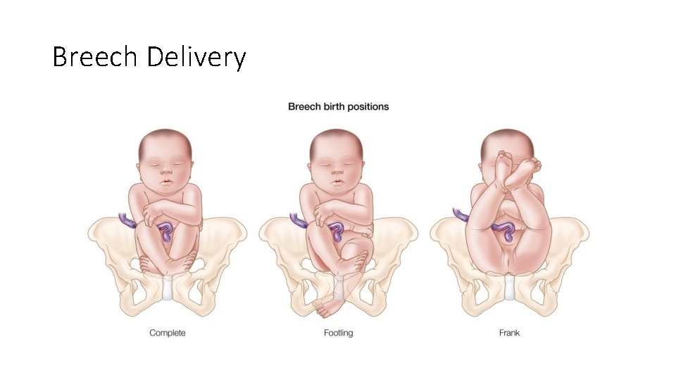 Obstetrical Emergencies Second Trimester Weeks 13 27 The