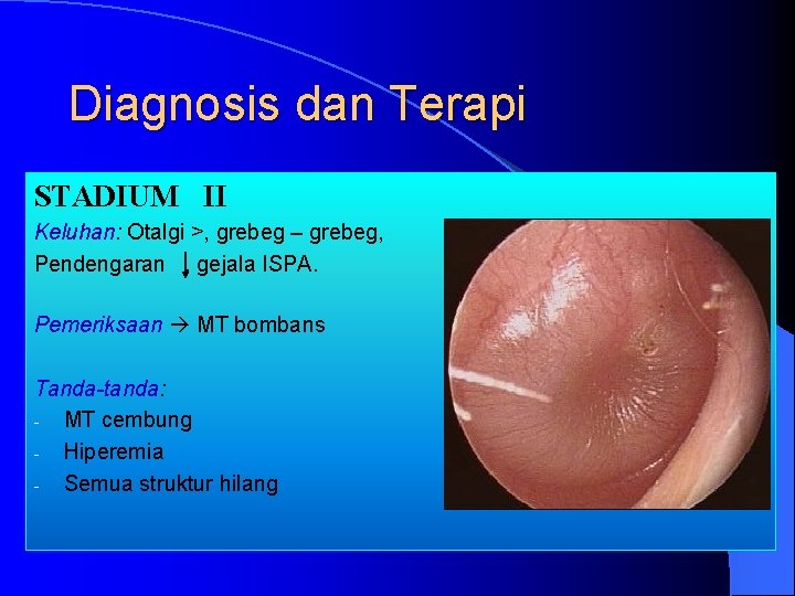 Diagnosis dan Terapi STADIUM II Keluhan: Otalgi >, grebeg – grebeg, Pendengaran , gejala