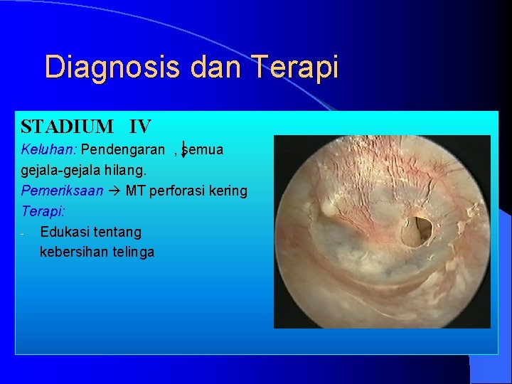 Diagnosis dan Terapi STADIUM IV Keluhan: Pendengaran , semua gejala-gejala hilang. Pemeriksaan MT perforasi