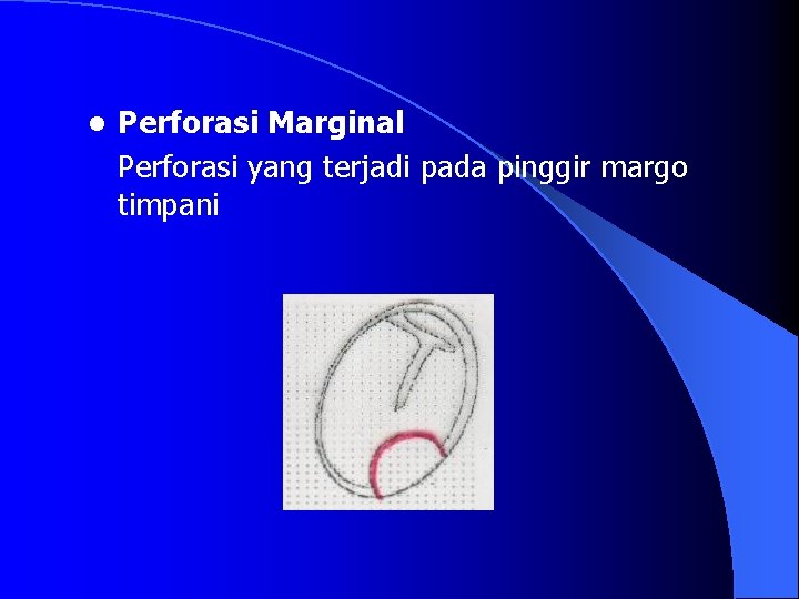 l Perforasi Marginal Perforasi yang terjadi pada pinggir margo timpani 