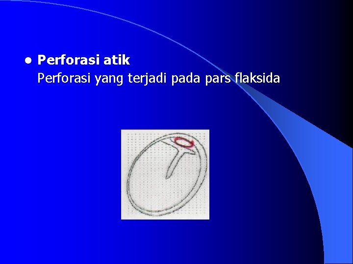 l Perforasi atik Perforasi yang terjadi pada pars flaksida 