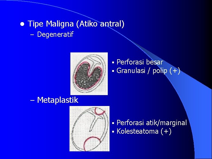 l Tipe Maligna (Atiko antral) – Degeneratif § § Perforasi besar Granulasi / polip