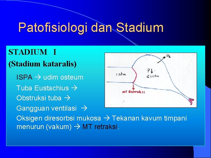 Patofisiologi dan Stadium STADIUM I (Stadium kataralis) ISPA udim osteum Tuba Eustachius Obstruksi tuba