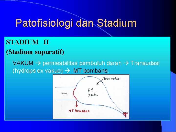 Patofisiologi dan Stadium STADIUM II (Stadium supuratif) VAKUM permeabilitas pembuluh darah Transudasi (hydrops ex