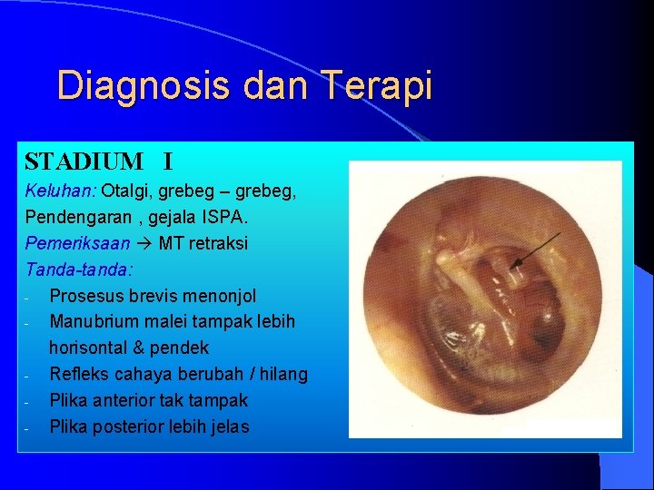 Diagnosis dan Terapi STADIUM I Keluhan: Otalgi, grebeg – grebeg, Pendengaran , gejala ISPA.