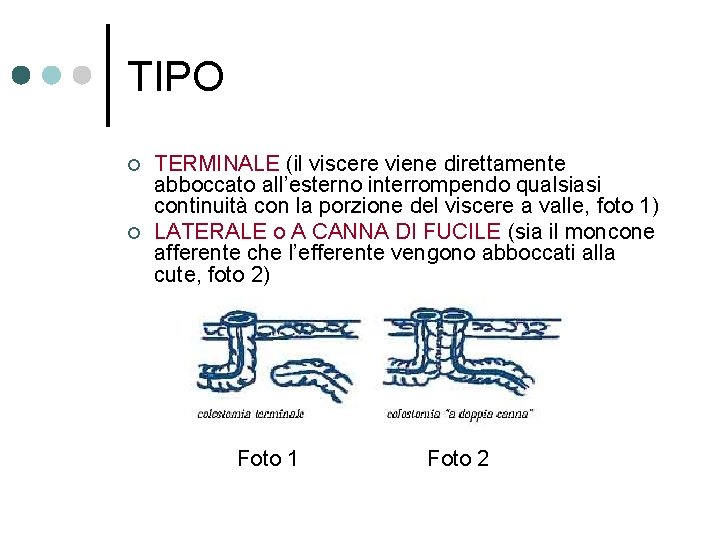 TIPO ¢ ¢ TERMINALE (il viscere viene direttamente abboccato all’esterno interrompendo qualsiasi continuità con