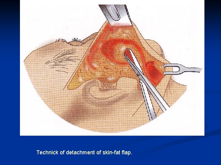 Technick of detachment of skin-fat flap. 