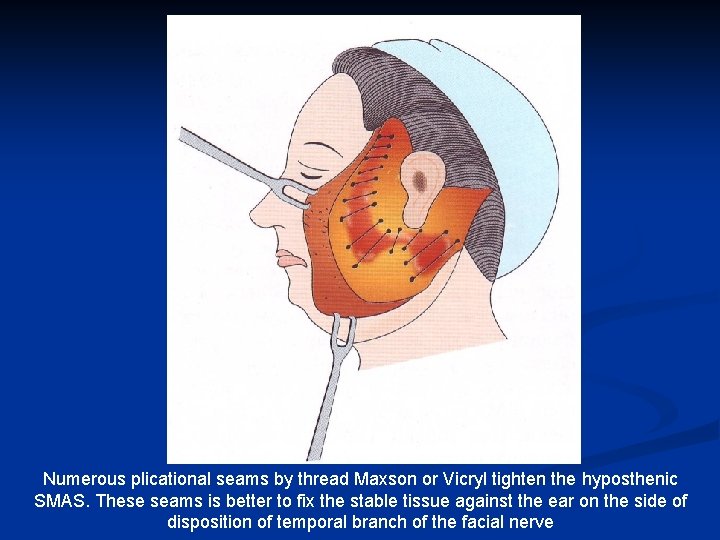 Numerous plicational seams by thread Maxson or Vicryl tighten the hyposthenic SMAS. These seams