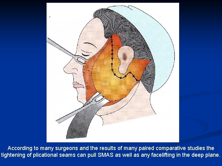 According to many surgeons and the results of many paired comparative studies the tightening