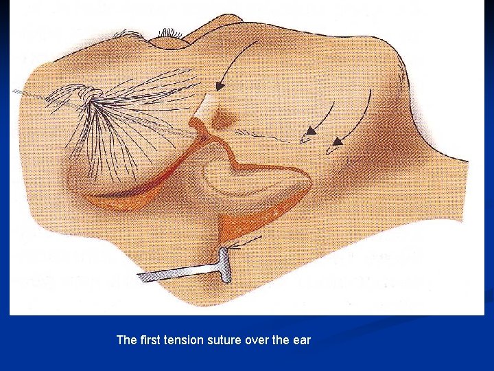 The first tension suture over the ear 