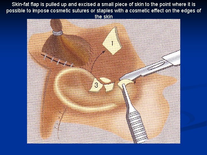 Skin-fat flap is pulled up and excised a small piece of skin to the