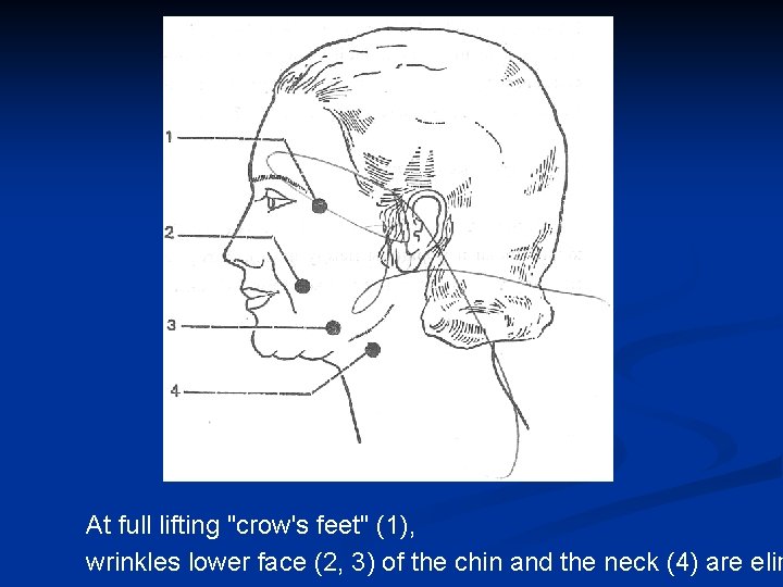 At full lifting "crow's feet" (1), wrinkles lower face (2, 3) of the chin