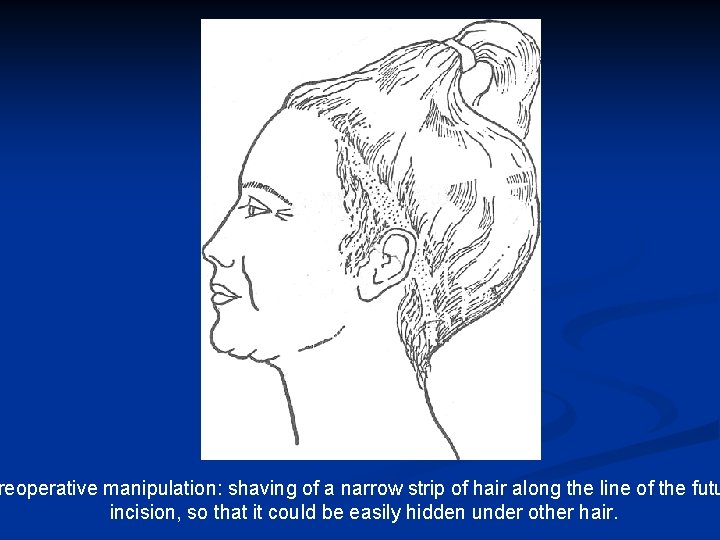 reoperative manipulation: shaving of a narrow strip of hair along the line of the