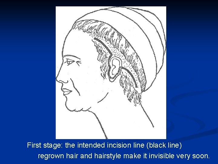 First stage: the intended incision line (black line) regrown hair and hairstyle make it