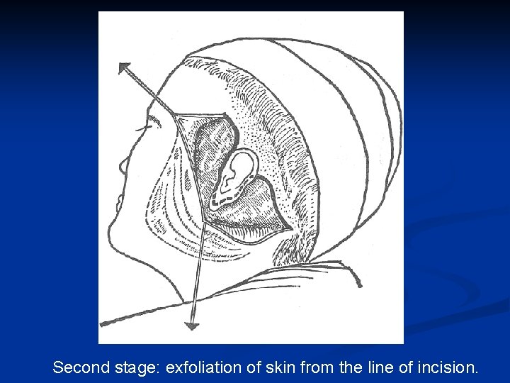 Second stage: exfoliation of skin from the line of incision. 