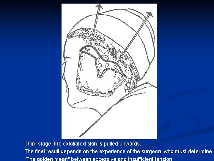 Third stage: the exfoliated skin is pulled upwards. The final result depends on the