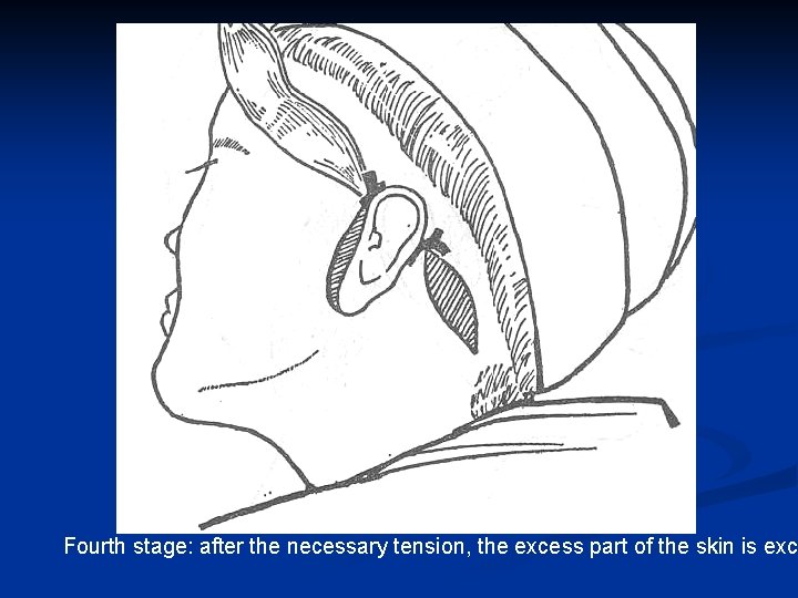 Fourth stage: after the necessary tension, the excess part of the skin is exci