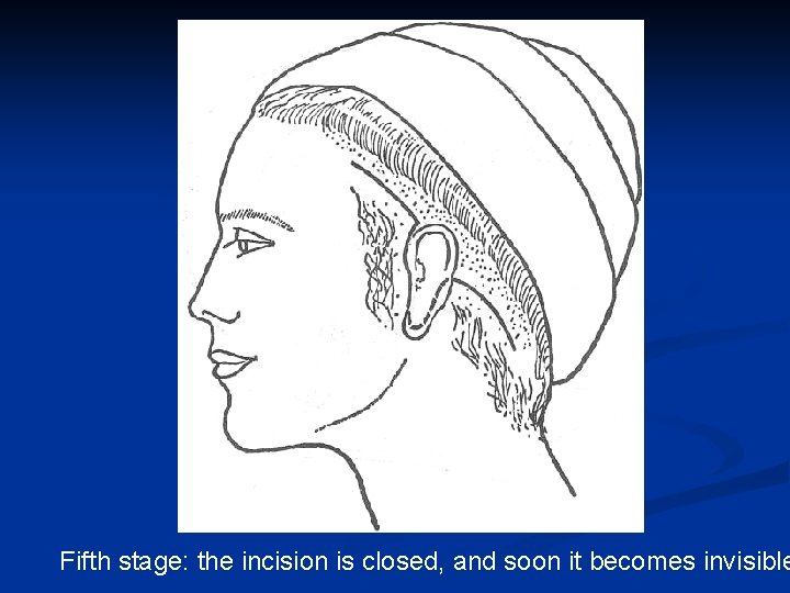 Fifth stage: the incision is closed, and soon it becomes invisible 