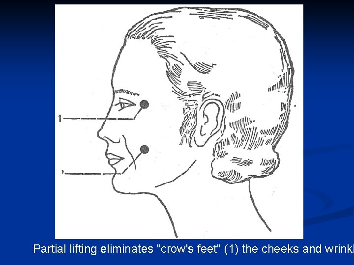 Partial lifting eliminates "crow's feet" (1) the cheeks and wrinkl 