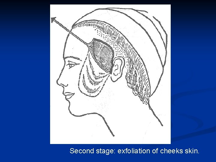 Second stage: exfoliation of cheeks skin. 