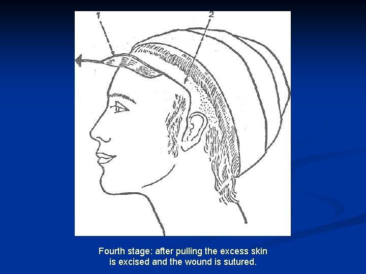 Fourth stage: after pulling the excess skin is excised and the wound is sutured.