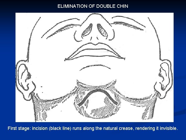 ELIMINATION OF DOUBLE CHIN First stage: incision (black line) runs along the natural crease,