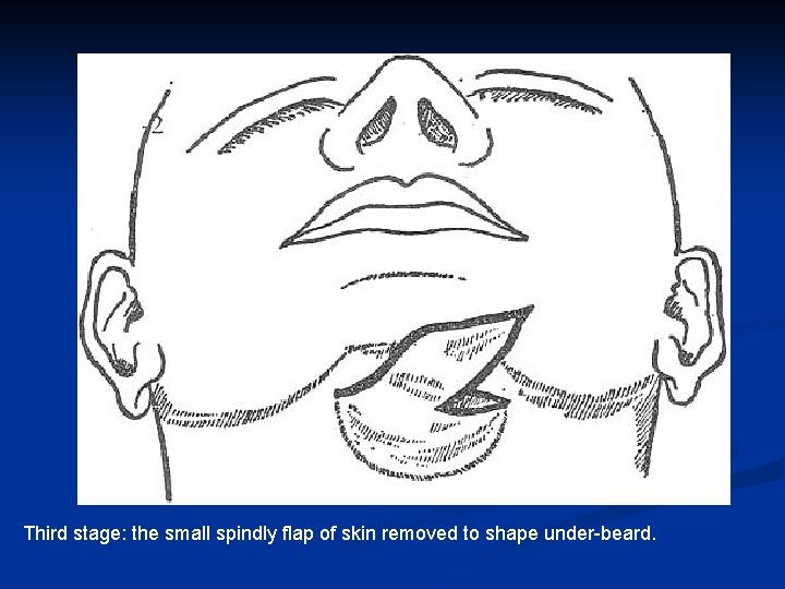 Third stage: the small spindly flap of skin removed to shape under-beard. 