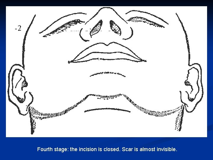 Fourth stage: the incision is closed. Scar is almost invisible. 