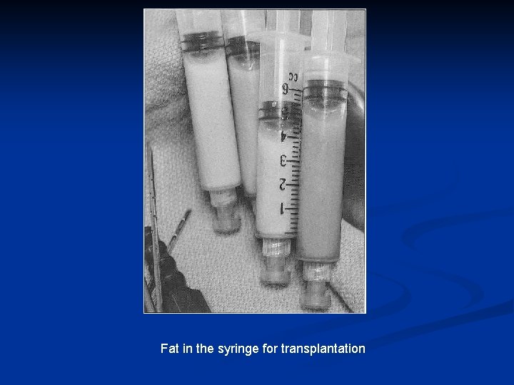 Fat in the syringe for transplantation 