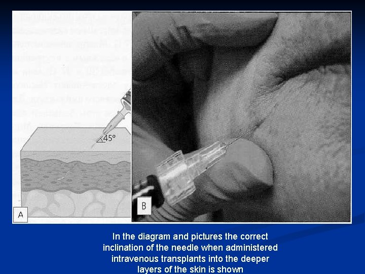 In the diagram and pictures the correct inclination of the needle when administered intravenous