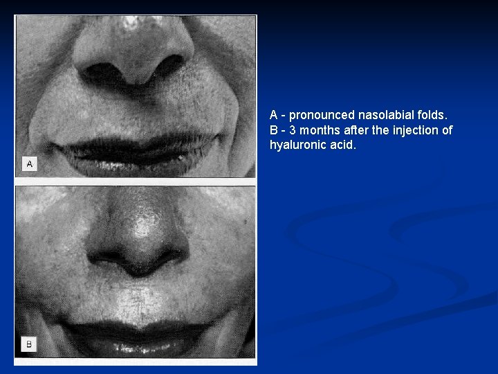 A - pronounced nasolabial folds. B - 3 months after the injection of hyaluronic