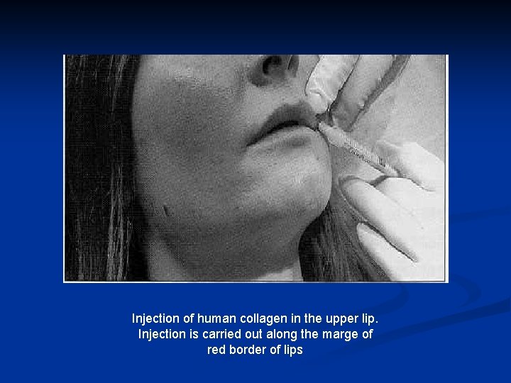 Injection of human collagen in the upper lip. Injection is carried out along the